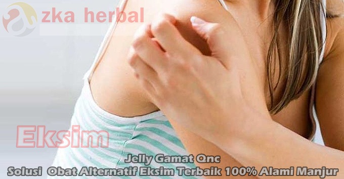 Obat Alternatif Eksim Terbaik 100% Alami Manjur