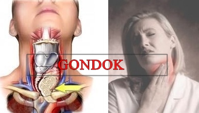 Obat Gondok Alami Dan Manjur
